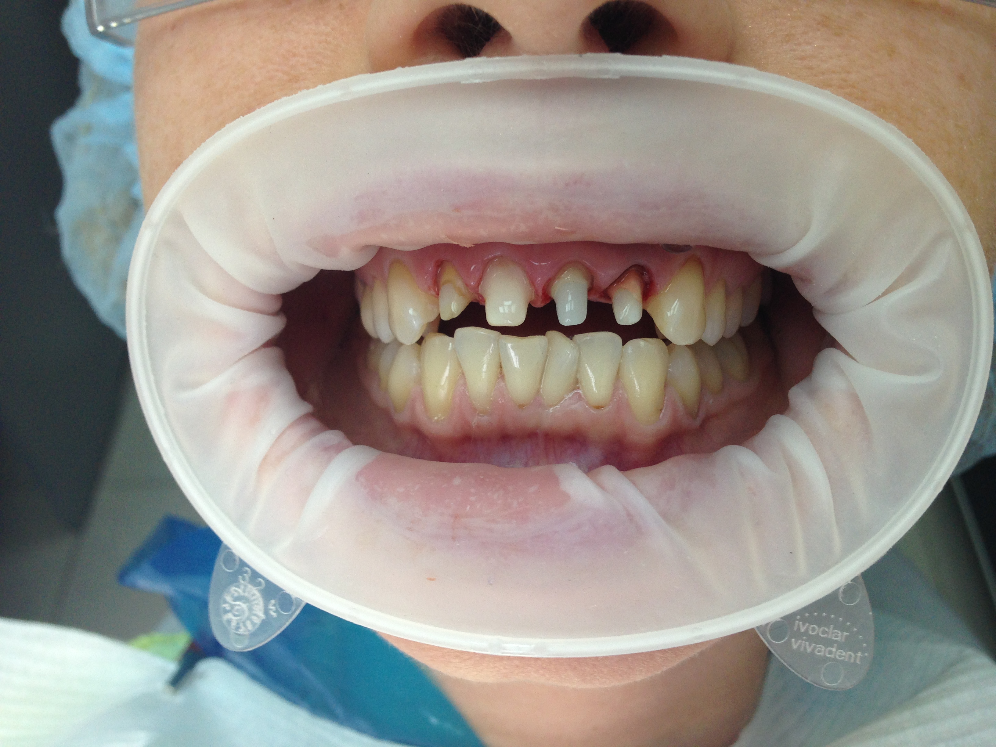 Пациент К-обточка зубов под безметалловые керамические коронки на основе циркония