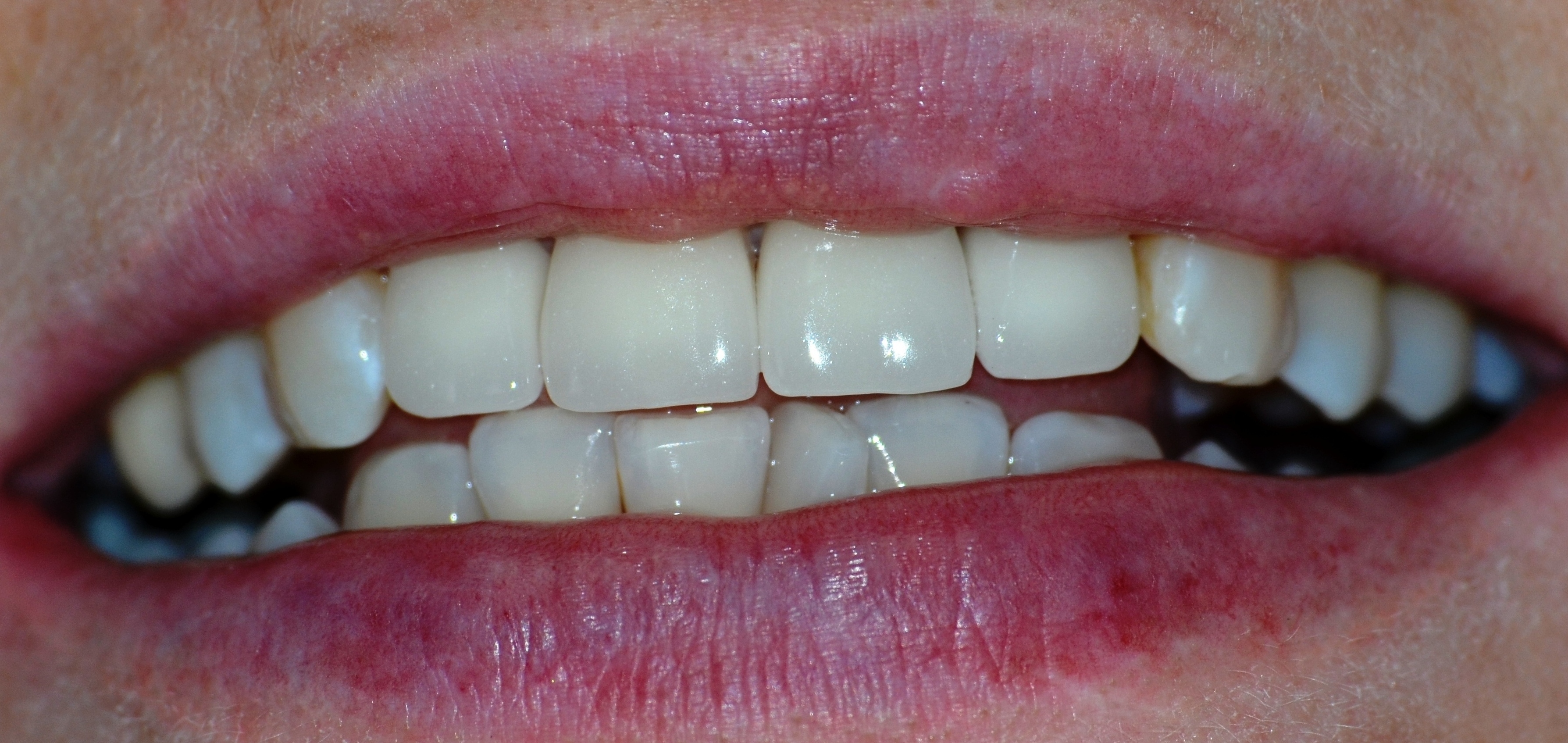b1 цвет зубов фото