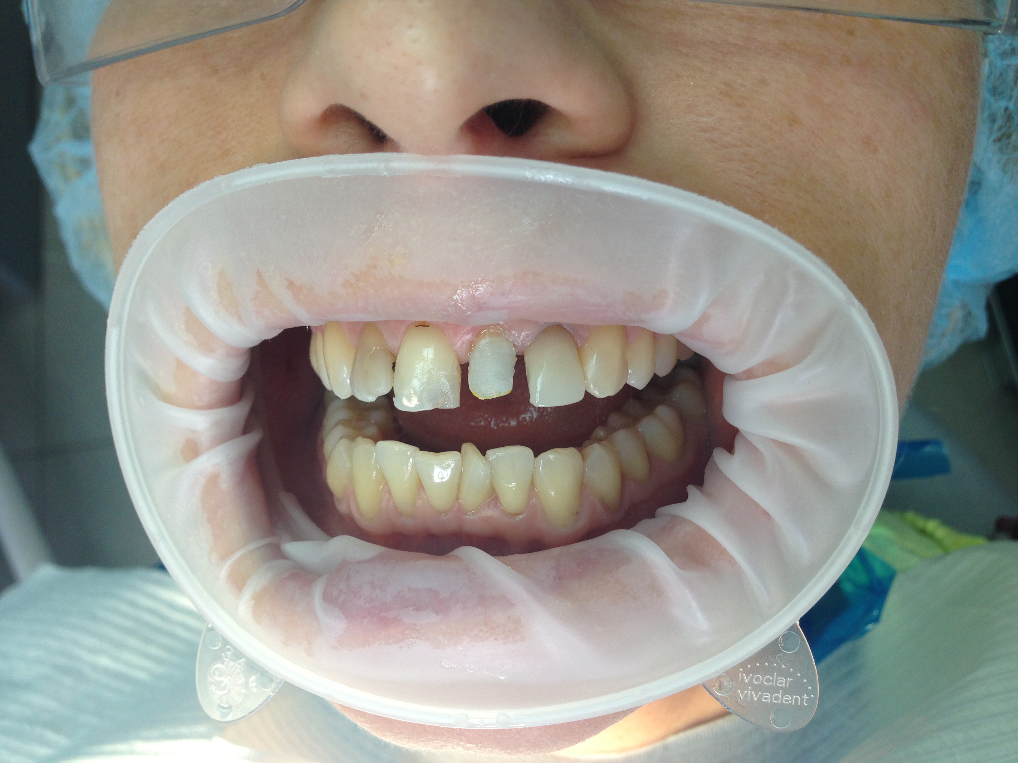 Пациент К-Восстановили 21 зуб материалом Максцем элит и стекловолоконным штифтом икадент (отличная альтернатива безметалловой вкладке)