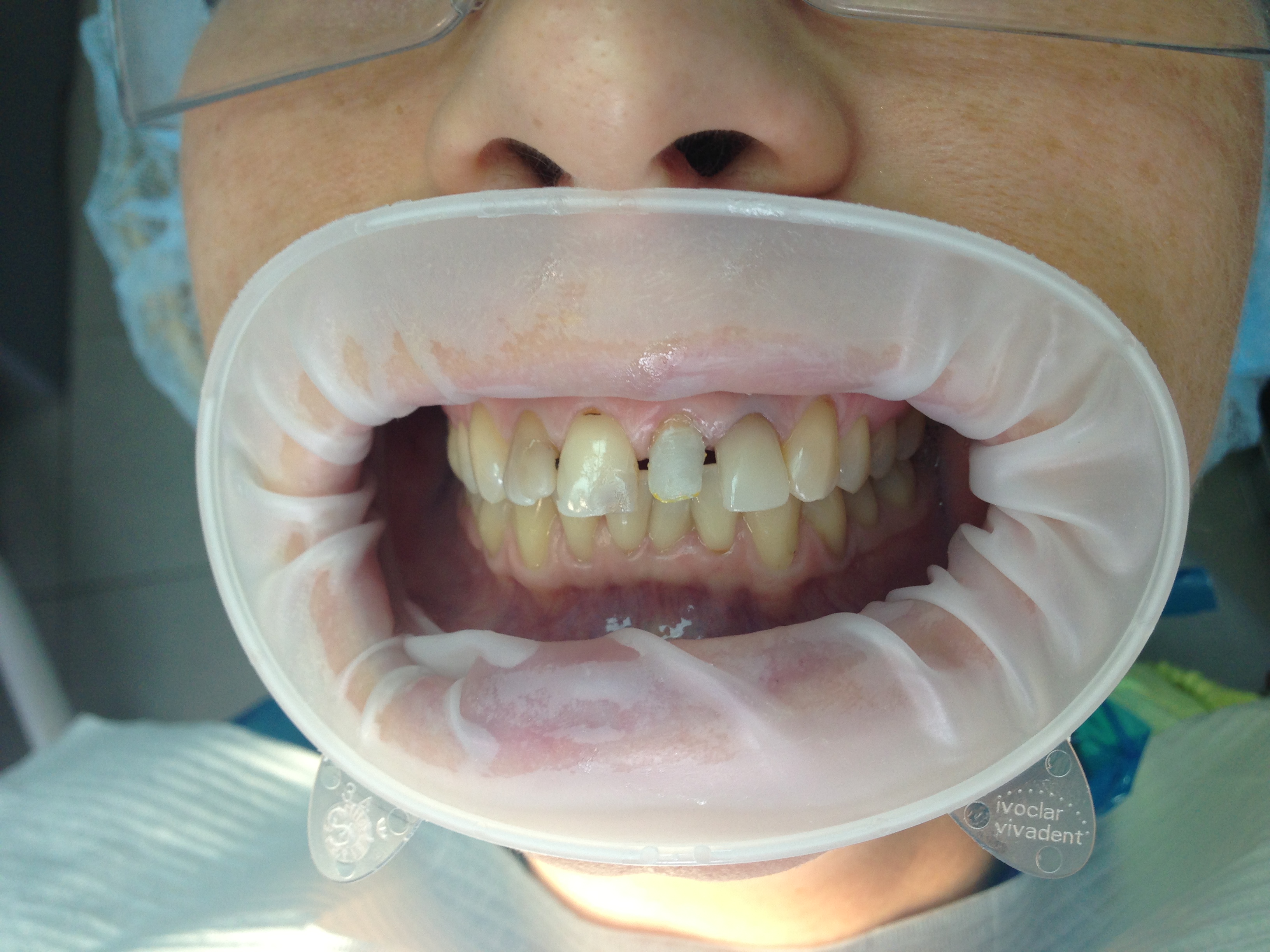 Пациент К-Восстановили 21 зуб материалом Максцем элит со стекловолоконным штифтом икадент