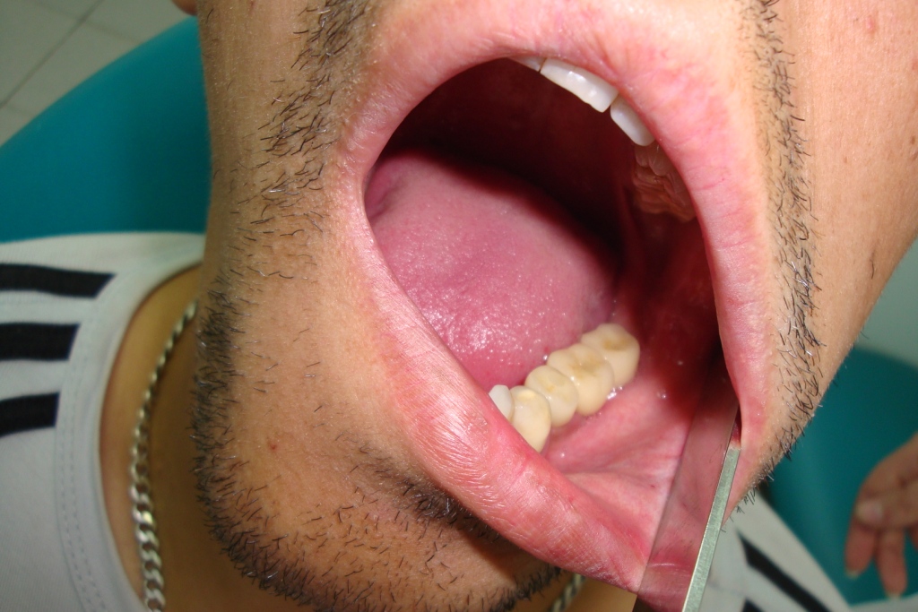 Пациент Д 7-После 3 месяцев,установили на 3 зуба безметалловые керамические коронки на основе циркония, абатменты под коронкой с циркониевой головкой, система фиксации коронки к абатменту винтовая-при необходимости можно снять и поставить обратно