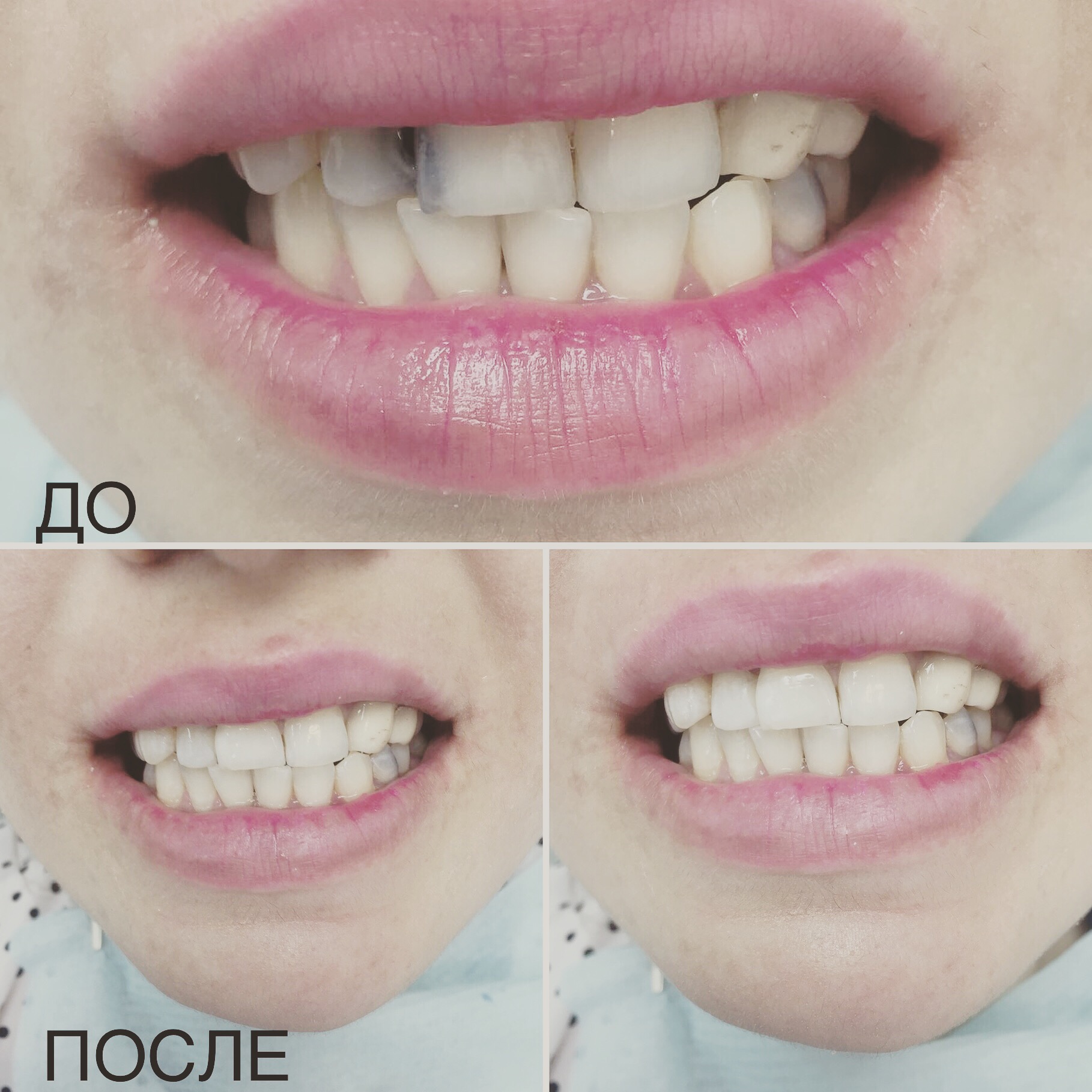 Реставрация зубов по режущему краю