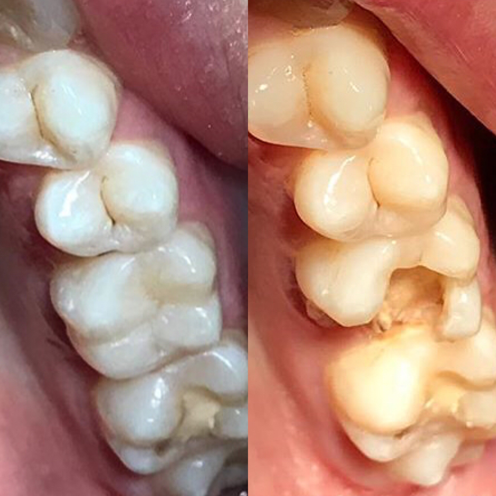 реставрация большого жевательного зуба 6-ки