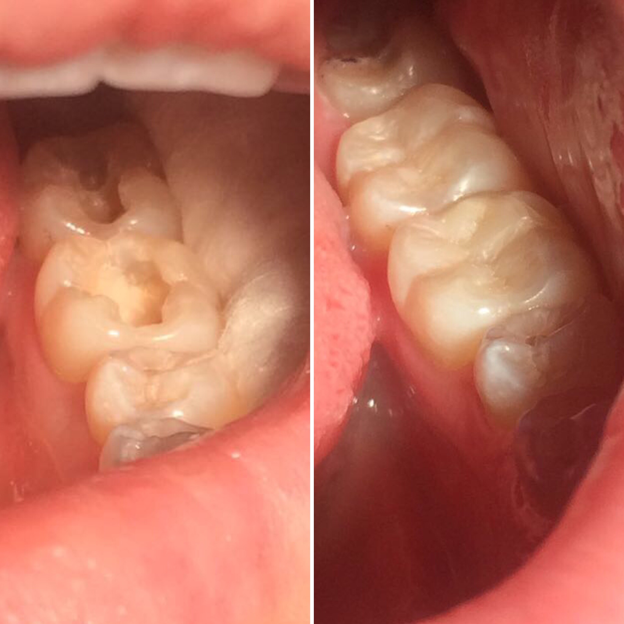Лечение кариеса на двух жевательных зубах