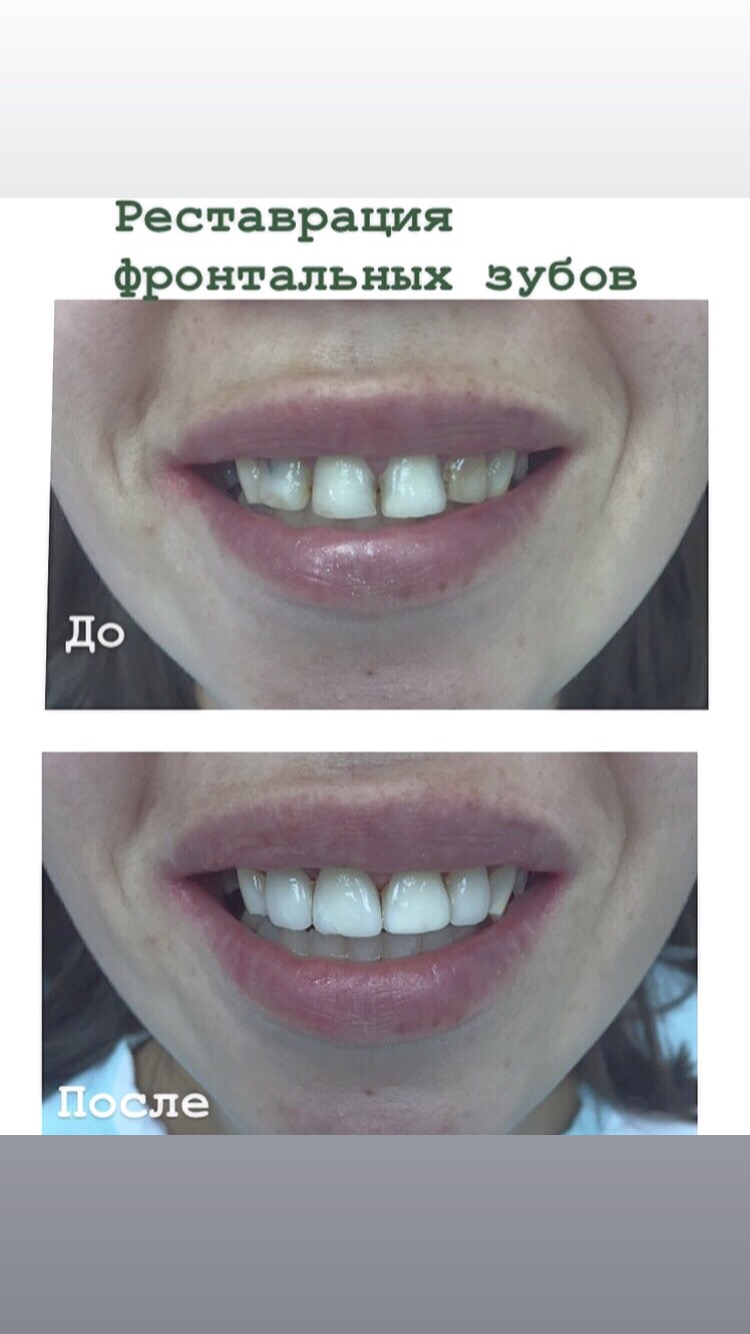 реставрация 4 передних зубов
