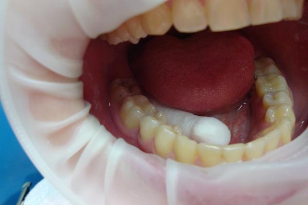 Пациент 46 зуб-световая пломба по 1 классу