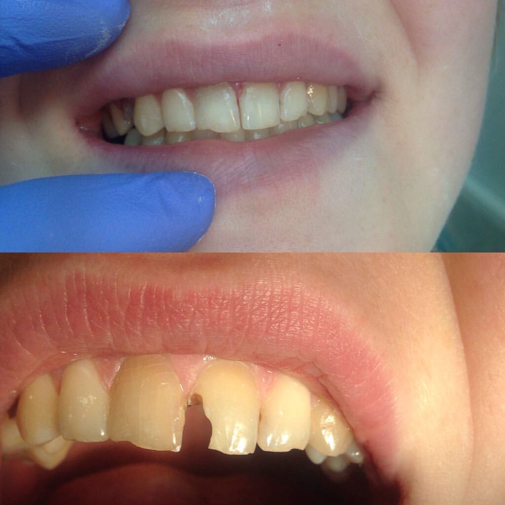 Реставрация переднего верхнего зуба