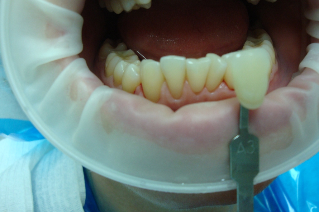 Пациент К-До отбеливания, на 4 верхних зубах временные коронки, решили отбелить зубы лазером,  пациент решила поставить безметалловую керамику на 4 передних верхних зуба, но светлее своих зубов цвета А3 осветлив их до А1
