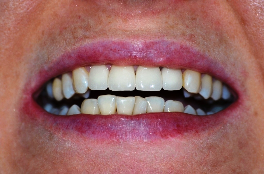 Пациент К-после отбеливания и последующей установки безметалловых коронок на 4 пердних вехних зуба, новый цвет всей улыбки А1. Важно помнить, что отбеливание надо делать до установки коронок и пломб на передних зубах