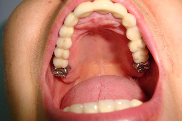 пациент Н- поставили цельную подкову-12 металлокерам.зубов и целнолитые с концов