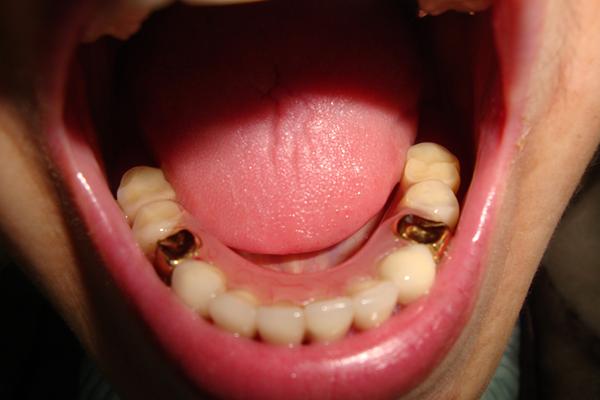 пациент Н-снизу поставили 6 металлокерам.зубов, с концов цельнолитые коронки с покрытием циркониевым и с концов по 2 зуба съемого протеза (вместо съмного протеза можно также поставить импланты)
