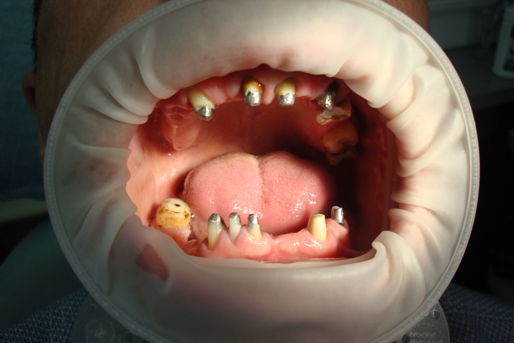 ПациентС установили вкладки под металлокерамические коронки на верхней и нижней челюсти