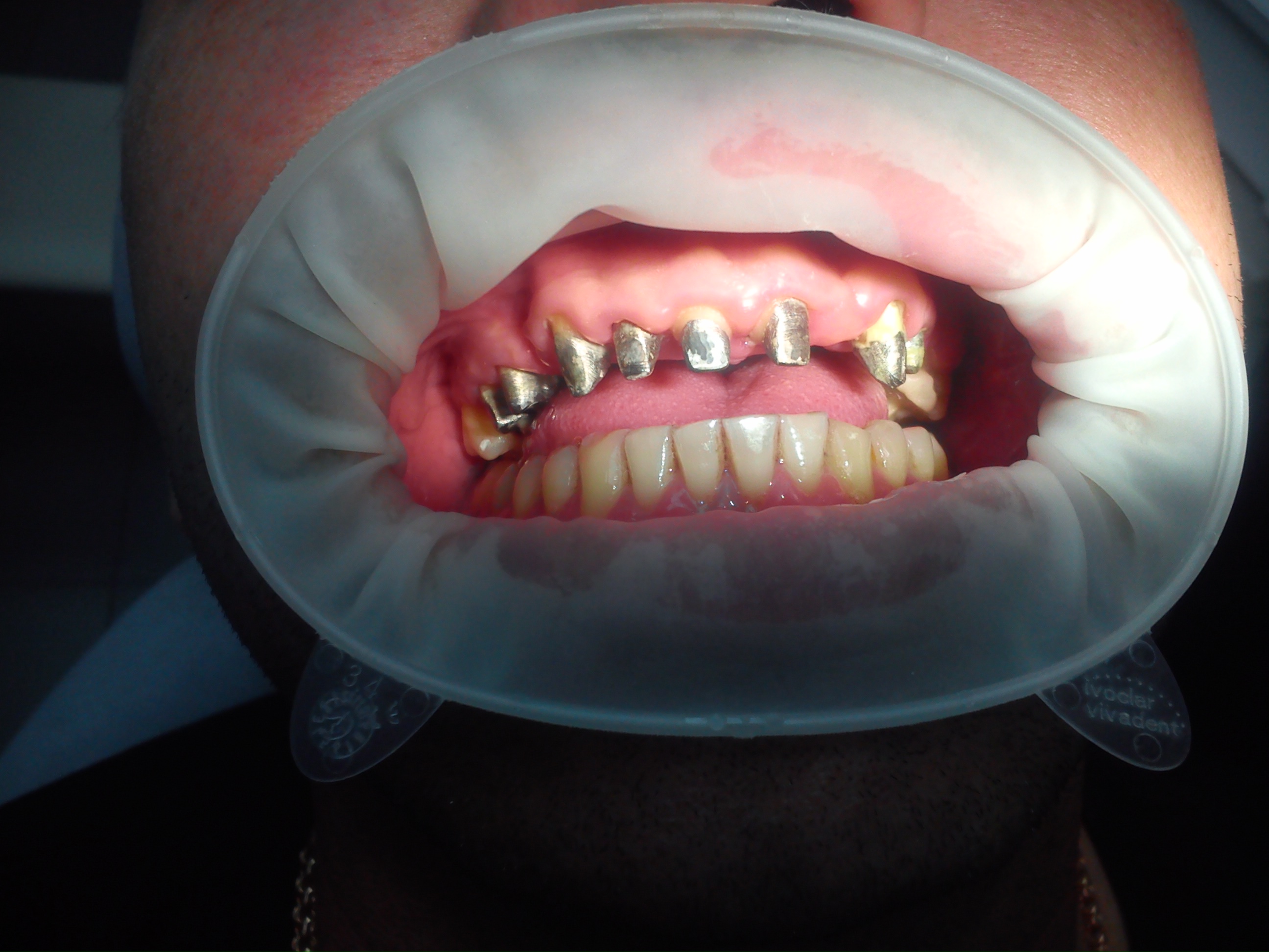 Пациент В-До:установили 8 вкладок, обточили с уступом под металлокерамические мосты с 1.6 зуба по 2.4 зуб, на место 2.5 и 2.6 зубы позже  поставим импланты