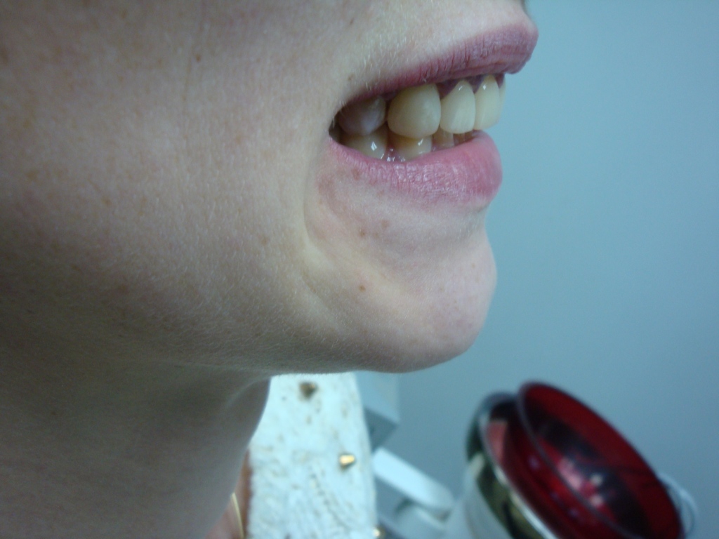 Пациент А-примерка во рту (вид сбоку, синий спрей на десне для примерки виниров)