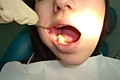 Пациент 46 зуб кариес 1 класса