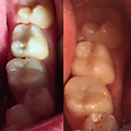 лечение 7 с заменой пломбы 7 зуба и нарастили стертый бугор 6 зуба