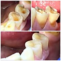 лечение при повышенной стираемости зубов, восстановили жевательную поверхность и шейки зубов-устранили клиновидный дефект