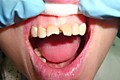 пациент ДО-21 зуб кариес 4 класса (2)