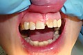 пациент ПОСЛЕ-21 зуб кариес 4 класса