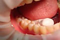Пациент 46 зуб(предпоследний зуб справа) вылечен кариес 1 класса(жевательная поверхность), установлена световая пломба Филтек Ультимейт, ЗМ
