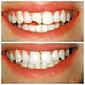 Реставрация верхнего переднего зуба