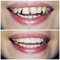 Реставрация 4 верхних передних зубов