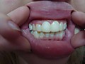 пациент К -оставили на время 4 пластмассовых колпачка+ 1 пустой зуб справа с десной для эстетики и закрытия промежутка (зубы свои не обтачивали), на время до установки Виниров