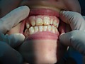 пациент К -жалоба на пигментацию от флюороза и неровное расположение зубов, рекомендованы виниры, но пациент пока отказался их ставить