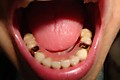 пациент Н-снизу поставили 6 металлокерам.зубов, с концов цельнолитые коронки с покрытием циркониевым и с концов по 2 зуба съемого протеза (вместо съмного протеза можно также поставить импланты)