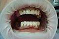 ПациентС установили металлокерамические мосты на верхнюю и на нижнюю челюсти. 4 зуба с искусственной керамичесской десной, где произошли раннее парадонтальные изменения уровня кости и слизистой. Далее пациенту будут ставить импланты на обе челюсти
