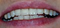 Пациент К-после отбеливания и после протезирования безметалловой керамикой верхних передних зубов