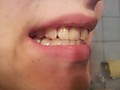 Пациент А- До (Жалоба на неровные зубы, не устраивает цвет и пятна на эмали, хочет быстро исправить неровный прикус, сделать зубы светлее и убрать пятна на эмали, брекеты ставить отказывается)