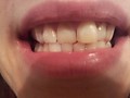 Пациент А-До (Решили установить виниры, т.к. эмаль своя эрозирована, пигментирована, отбеливание с такой эмалью не рекомендуется,за 8 дней исправить прикус с миним. обтачиванием и сохранен.зубов возможно винирами)