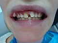 Пациент А-обточка зубов (видны эрозии и пигментация, снимается только верхний слой эмали с передней части зуба-создается небольшое ложе для винира)