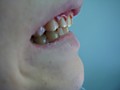 Пациент А-обточка зубов-снятие верхнего слоя эмали с губной стороны и сошлифовывание выступающих из дуги частей зуба для исправления прикуса