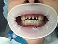 Пациент К-обточка зубов под безметалловые кеамические коронки на основе циркония