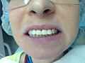 Пациент К-после обточки с временными коронками. Свой цвет А3-немного желтоват, после провели лазерное отбеливание зубов до естественного к цвета А1.