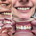 Паиент счастлив, Всегда хотела красивые ровные белые зубы и без брекетов, срок лечения составил 7дней